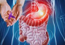 Cancro allo stomaco, spesso si ignora il primo sintomo: in realtà è quello più importante, ecco come riconoscerlo