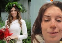 Crans-Montana, dimessi due ragazzi. Eleonora Palmieri mostra il volto ustionato sui social