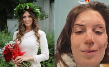 Crans-Montana, dimessi due ragazzi. Eleonora Palmieri mostra il volto ustionato sui social